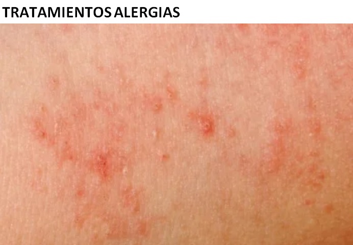tratamientos alergias