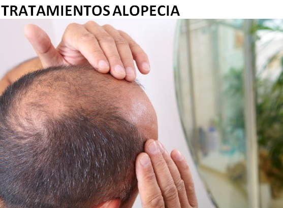 tratamientos alopecia talca