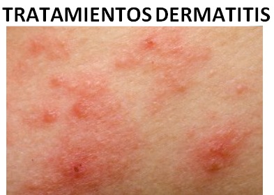 tratamientos dermatitis
